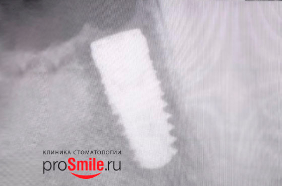 Признаки того, что зубной имплантат не прижился (произошло его отторжение или развился периимплантит)