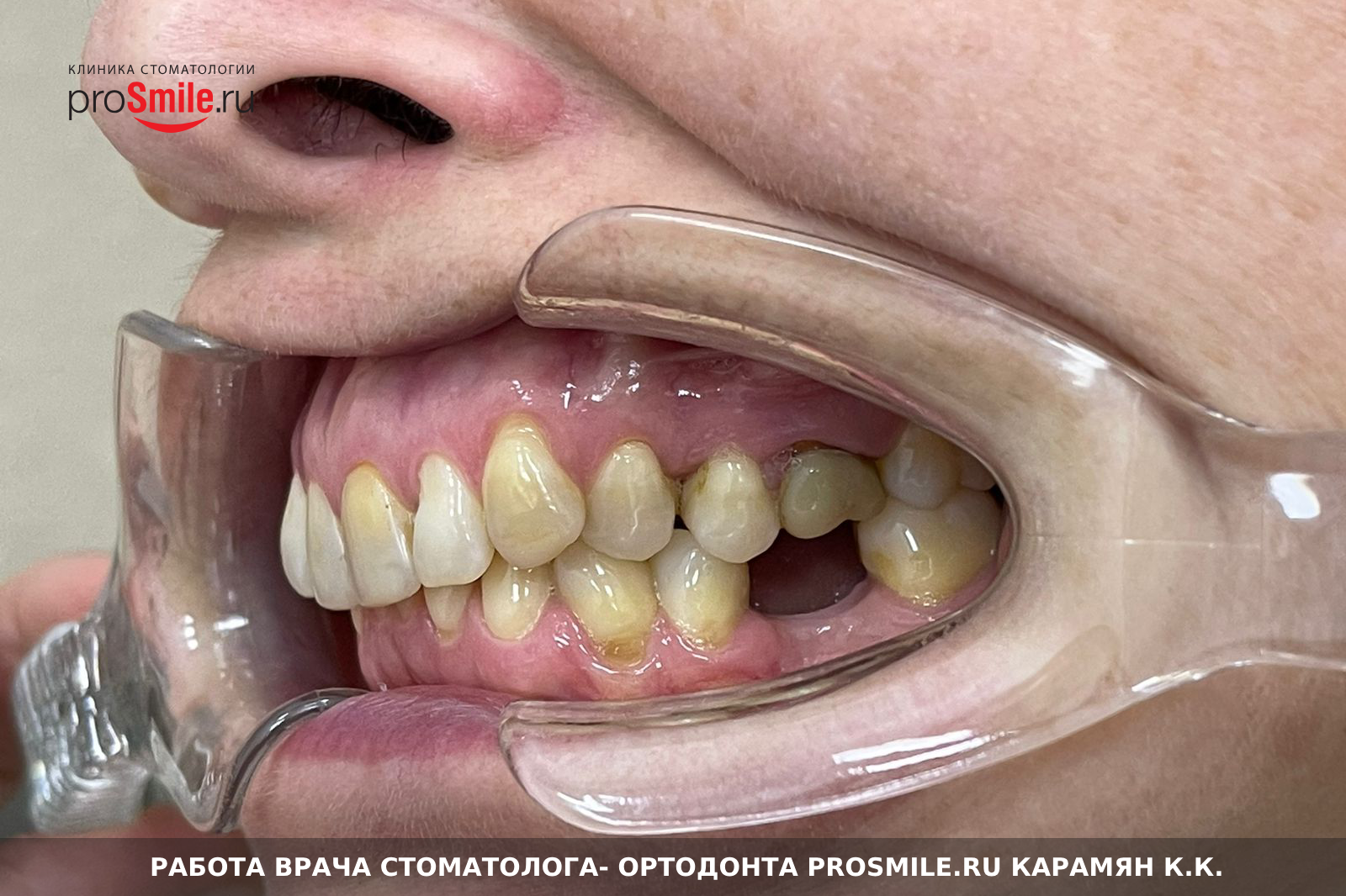 Работа врача стоматолога-ортодонта Просмайл.РУ Карамян К.К.