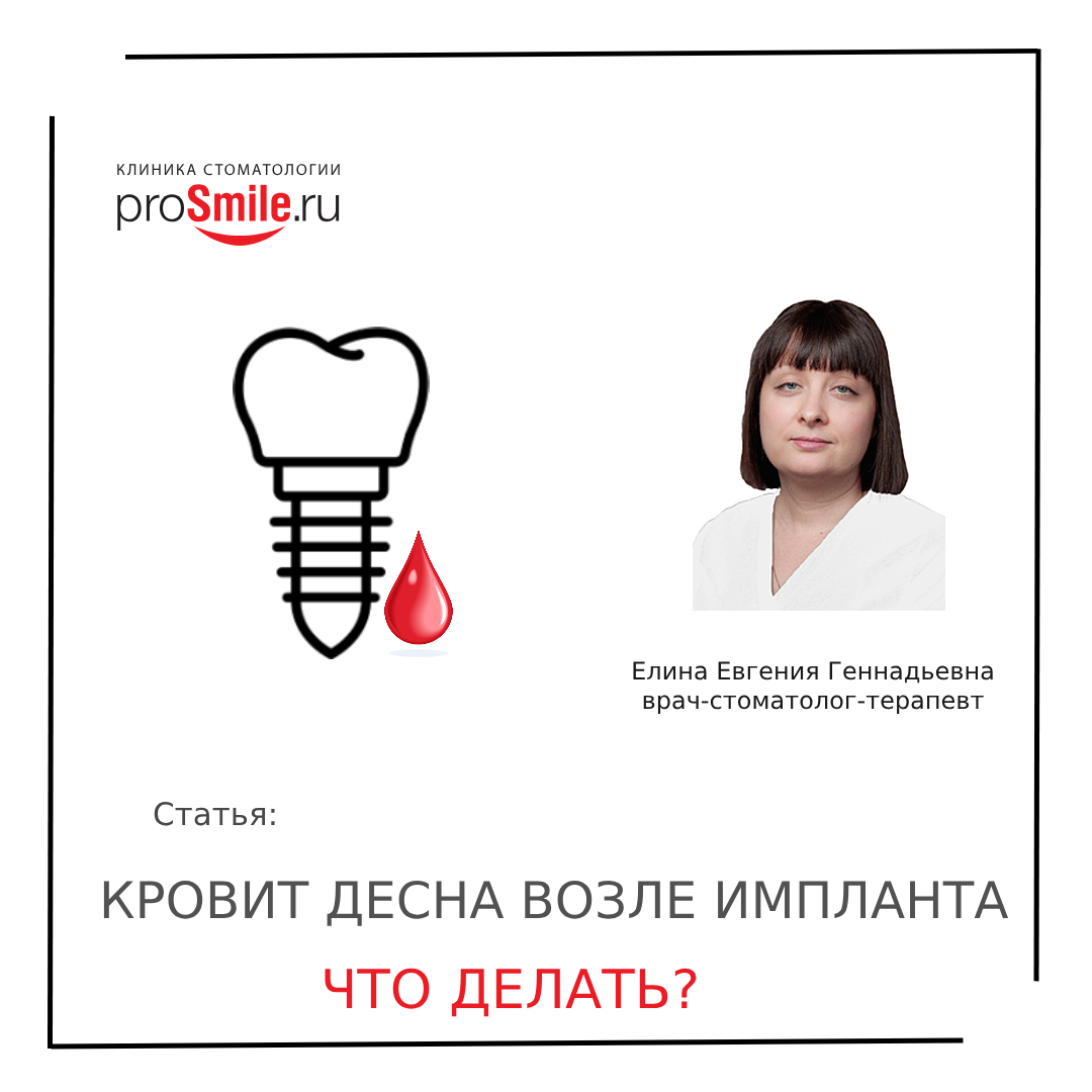 Что делать, когда кровит десна возле импланта?