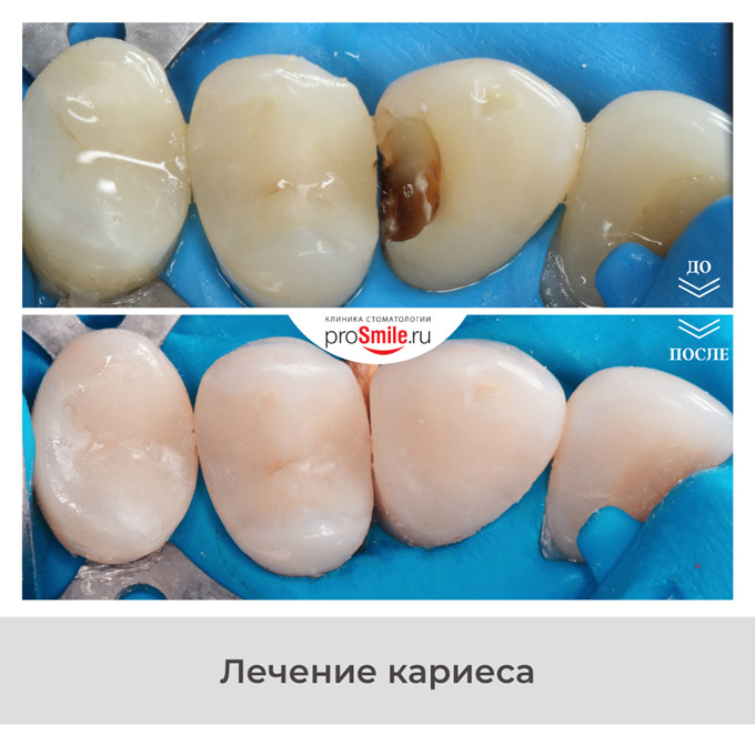 Лечение кариеса ICON Томск Усть-Киргизский 2-й лечение зуба томск