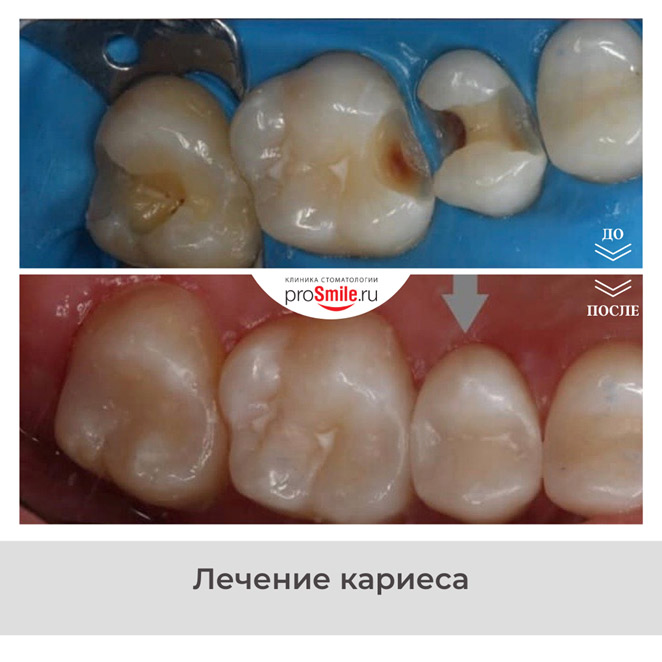 Лечение кариеса в стоматологии Просмайл.РУ