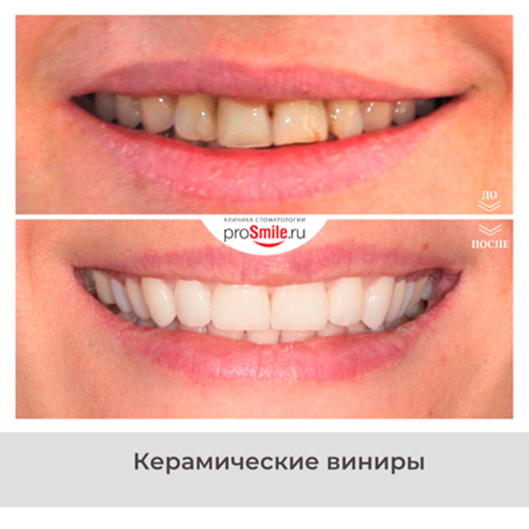 Отбеливание  зубов в стоматологии Просмайл.РУ