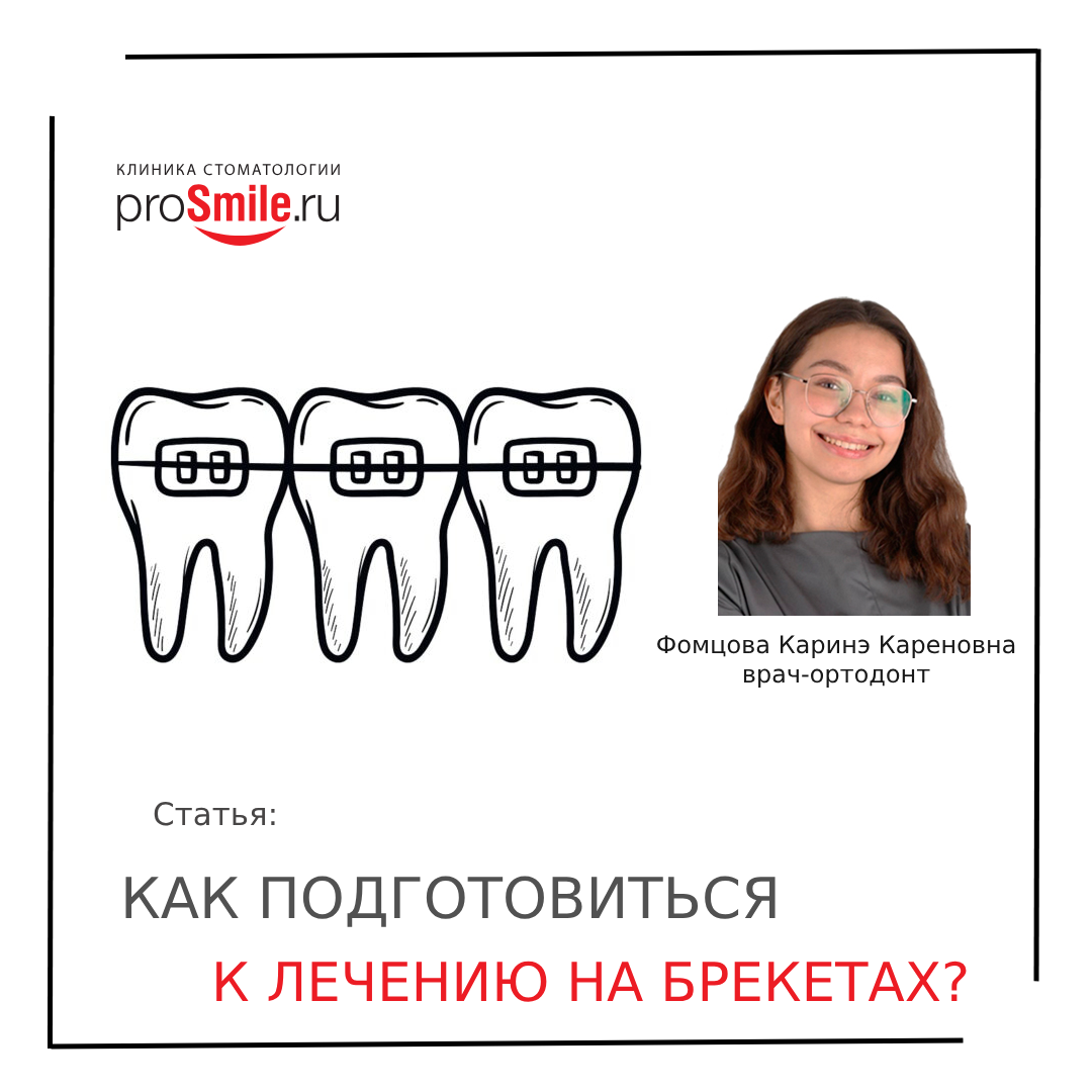 Как подготовиться к лечению на брекетах?