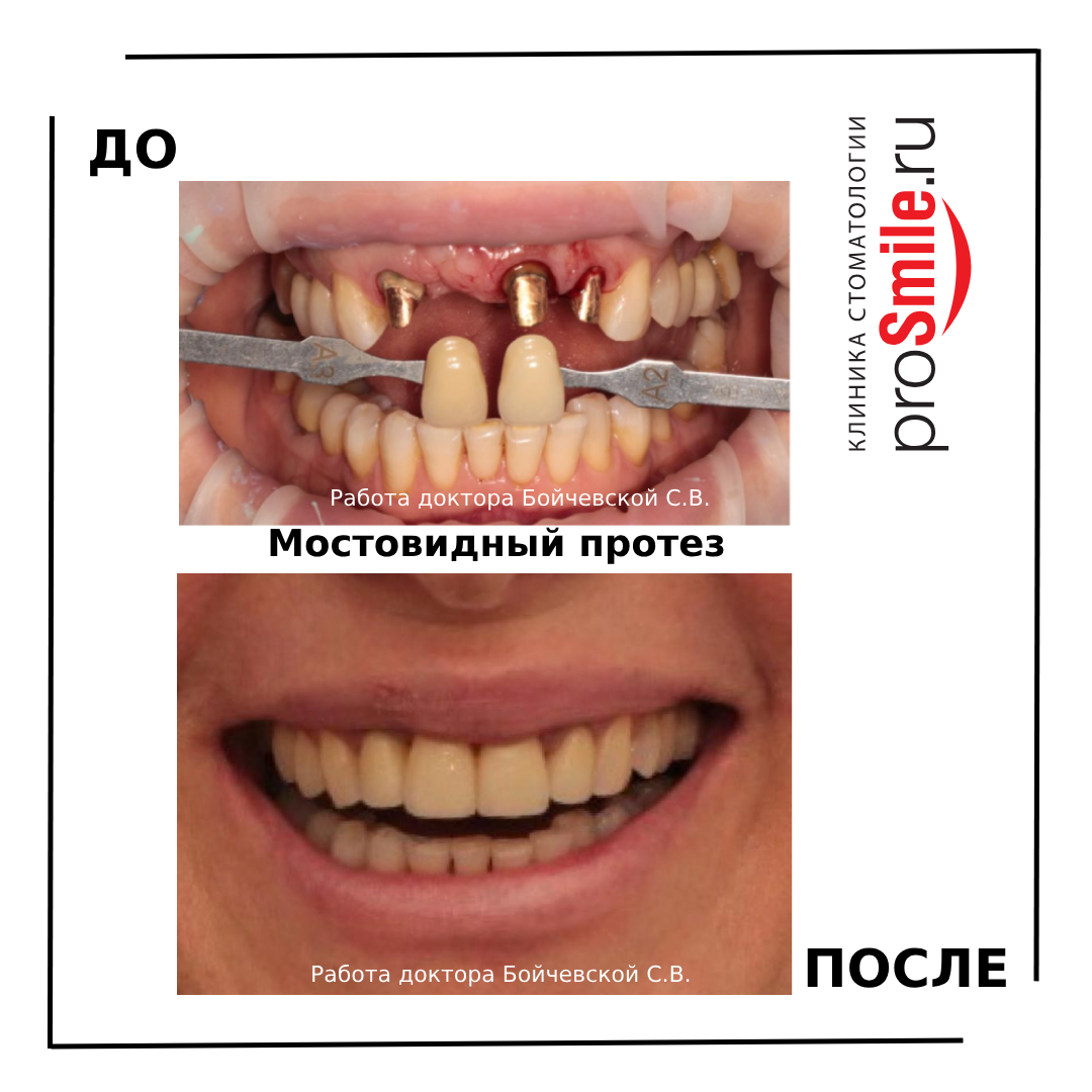 Преимущества и недостатки «зубного моста»