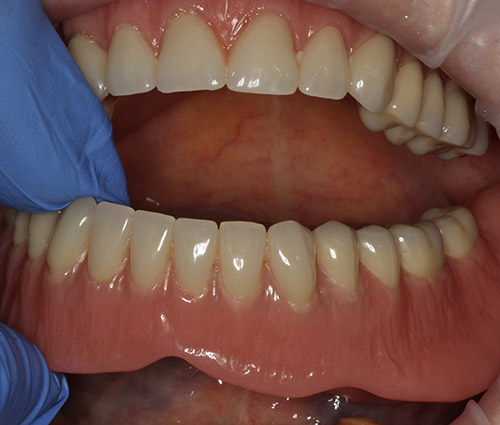 Частичный съемный протез зубов – виды, фото, отзывы