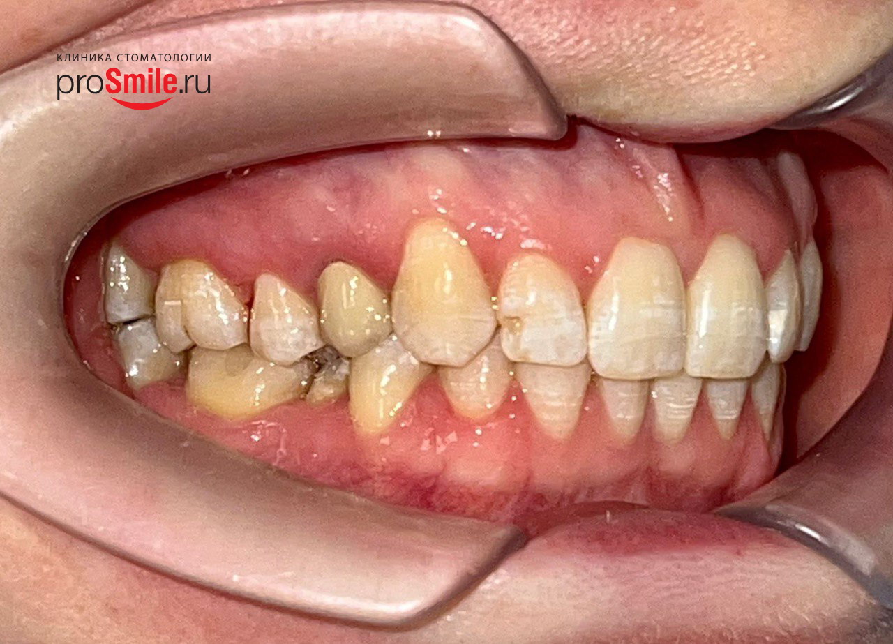 Шатается зуб: причины подвижности зубов, лечение - стоматология Блеск Новосибирск