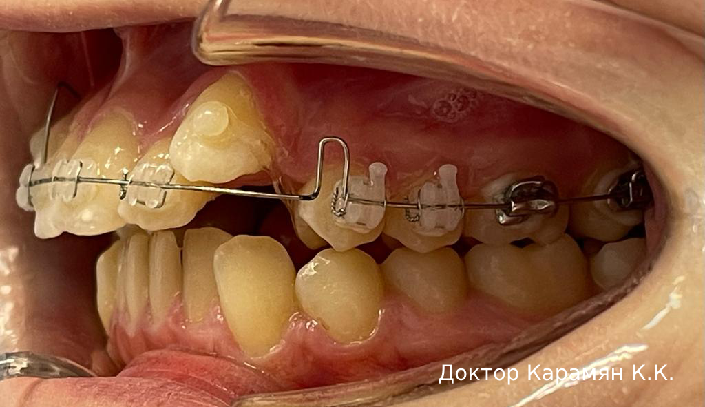 Исправление выступающих клыков в стоматологии Просмайл.РУ